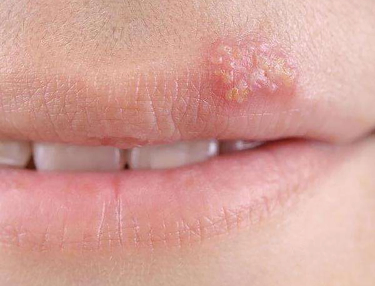 She has a lot of small blisters on the upper left corner of her lip when she is infected with herpes simplex.