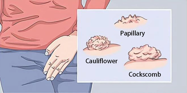 Three symptoms of genital warts: cauliflower-shaped, nipple-shaped, and cockscomb-shaped.