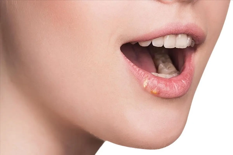 A young girl has a small herpes patch at the corner of her mouth.