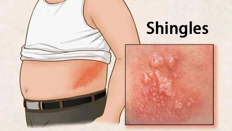 Symptoms of shingles on the waist.