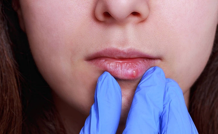 She has a blister in her mouth and is being examined.