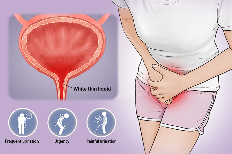 The woman suffered from non-gonococcal urethritis, usually accompanied by white thin liquid, frequent urination, urgency, and pain when urinating.