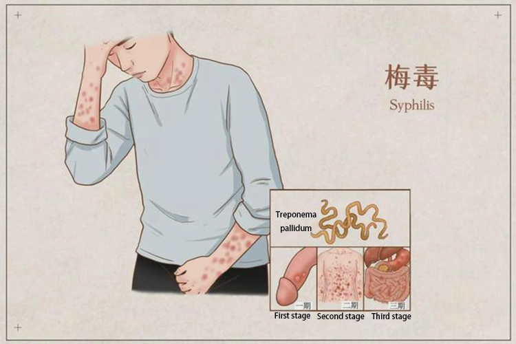 Syphilis pathogens and symptoms of the first, second and third stages.