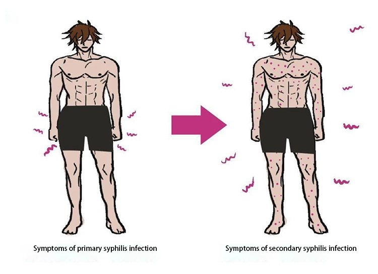 Comparison of symptoms from the first stage to the second stage after syphilis infection.