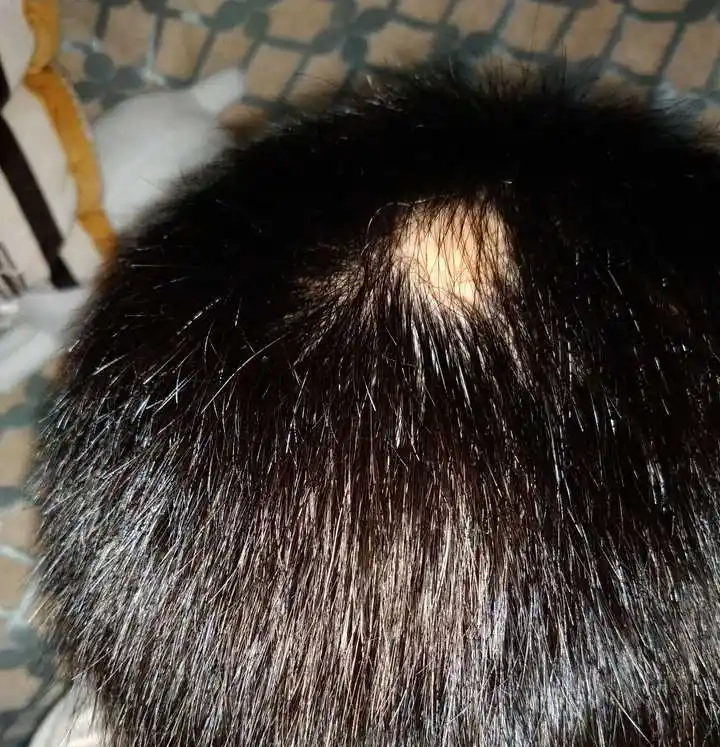 There is an obvious alopecia areata on his hair.