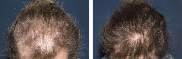 Comparison before and after treatment of psoriatic alopecia.