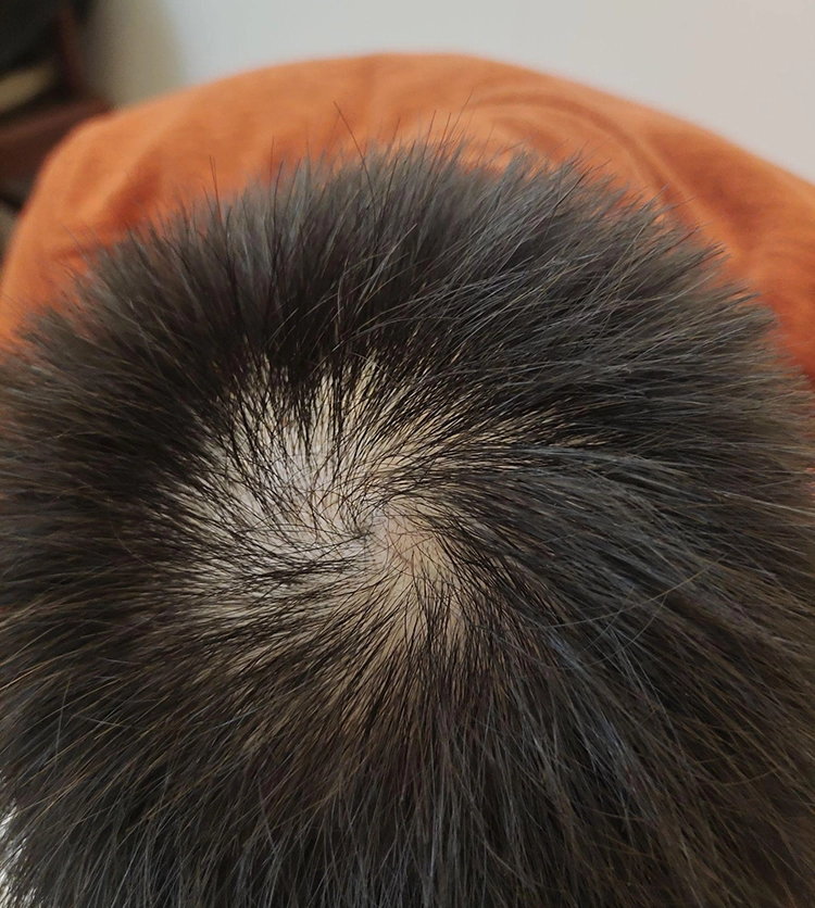 The hair of a teenager is thinner in the center of his hair.