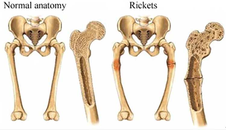 Comparison of leg shape between rickets and normal people.