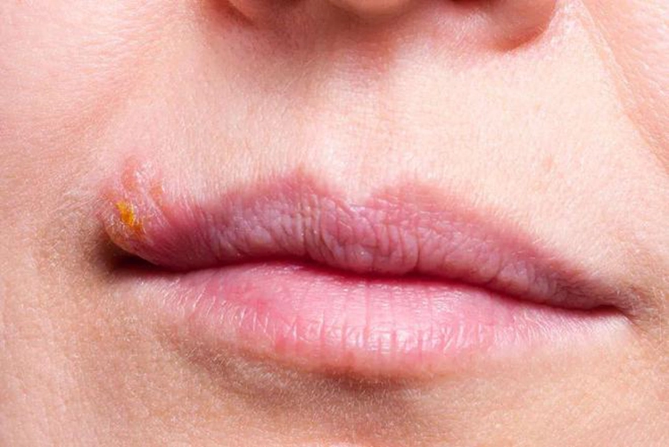 The small blisters in the upper right corner of the patient's mouth have scabs.