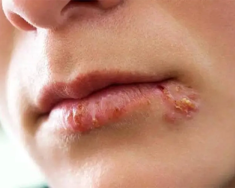 She has a small herpes patch at the corner of her mouth.