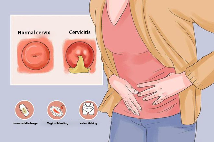 The manifestations of cervicitis and normal cervix in patients with gonorrhea.