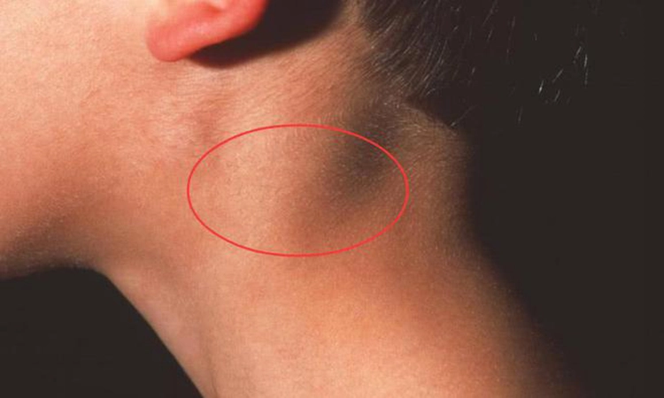 Lymphadenopathy in the neck of AIDS patients.