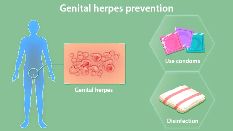 The way to prevent patients with genital herpes is to wear condoms and disinfect.