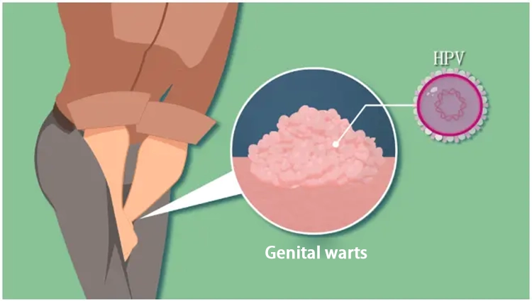 Patients with genital warts have cauliflower-like growths in their private parts.