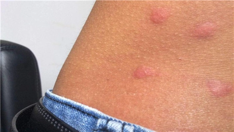 Symptoms of primary syphilis after contracting syphilis.